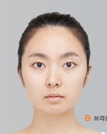 Rhinoplasty