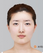 Rhinoplasty