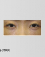 eye surgery