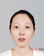 Rhinoplasty