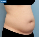 Liposuction