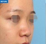 Rhinoplasty