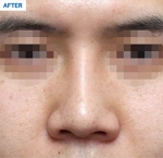 Rhinoplasty