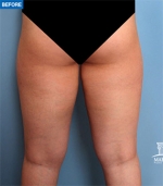 Liposuction