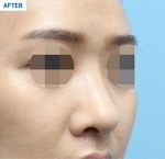 Rhinoplasty