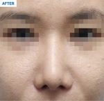 Rhinoplasty