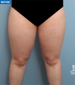 Liposuction