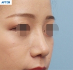 Rhinoplasty