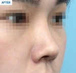 Rhinoplasty