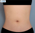 Liposuction