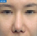 Rhinoplasty