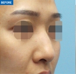 Rhinoplasty