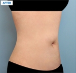 Liposuction