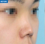 Rhinoplasty