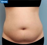 Liposuction