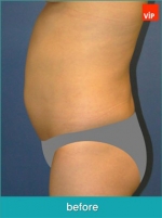 Liposuction