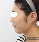 Rhinoplasty