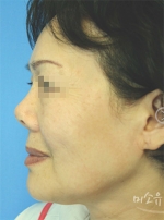 Rhinoplasty