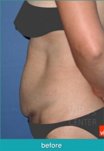 Liposuction