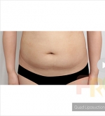 Liposuction