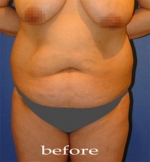 Liposuction