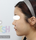 Rhinoplasty