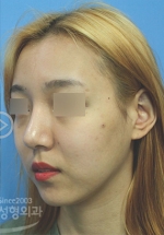 Rhinoplasty