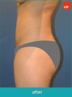 Liposuction