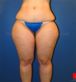 Liposuction