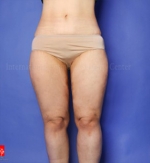 Liposuction