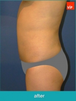 Liposuction