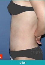 Liposuction