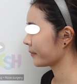 Rhinoplasty