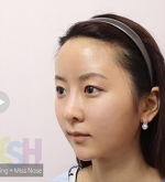 Rhinoplasty