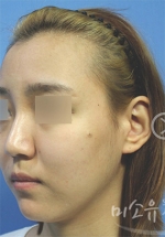 Rhinoplasty