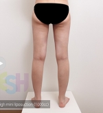 Liposuction