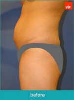 Liposuction