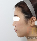 Rhinoplasty