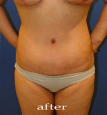 Liposuction