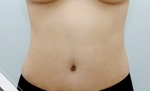 Liposuction