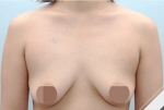 Breast Augmentation Surgery