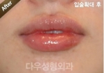 lip