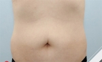 Liposuction