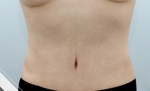 Liposuction