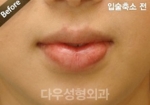 lip