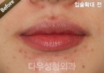 lip