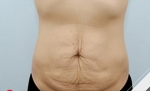 Liposuction