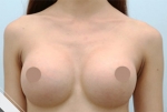 breast