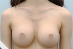 breast