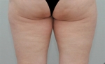 Liposuction